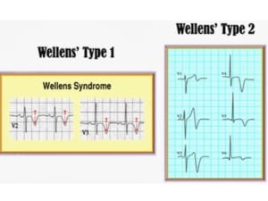 Landmines that Kill on the 12 Lead EKG: Wellen’s Sign - CME4LIFE